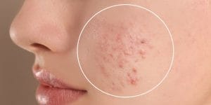 Acnee – Cauze, Tratamente, Remedii Naturale și Sfaturi Locale