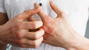 Dermatita atopică