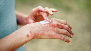 Eczema (Dermatita atopică)