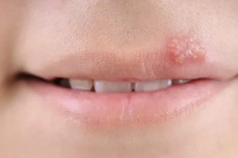 Herpes simplex