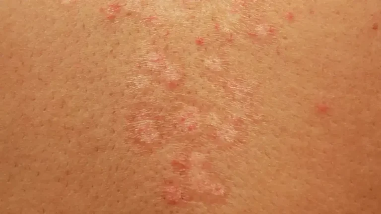 Infecțiile fungice ale pielii