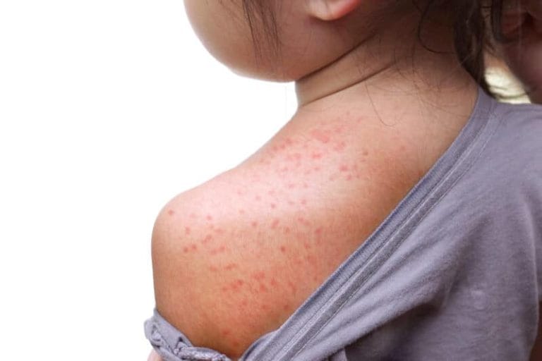 Red rash on baby skin at the back / Roseola infantum / Exanthema