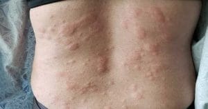 Urticaria