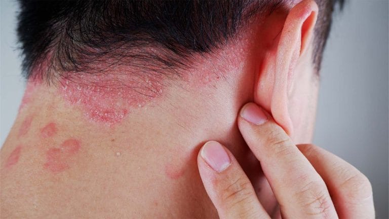 psoriazis simptome și tratament